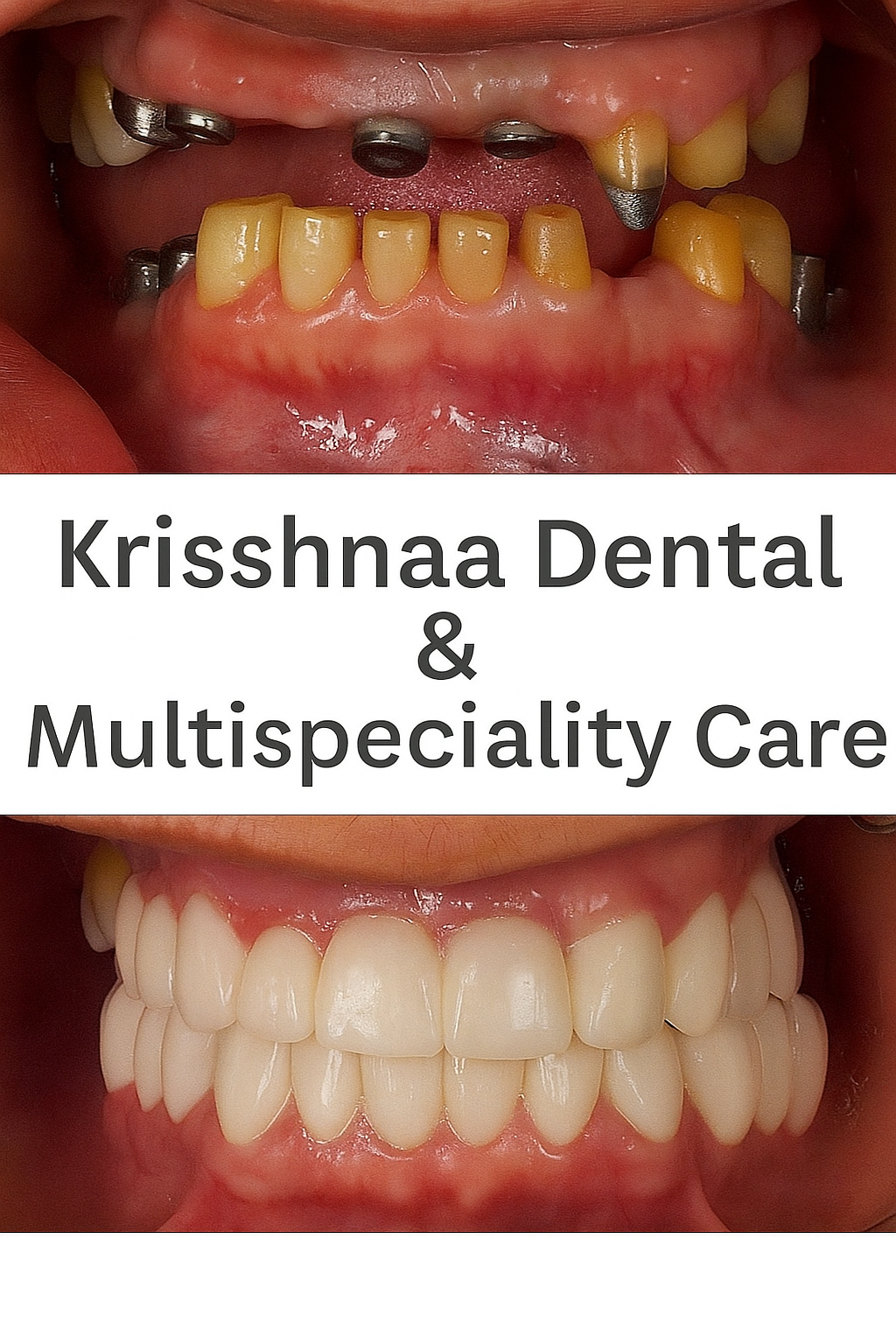 Latest Advances in Dental Implant Technology for 2025 – Krisshnaa Dental & Multispeciality Care, Karol Bagh, Delhi